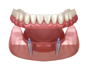 implant lower denture