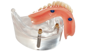 locators-overdenture